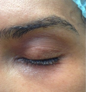 periocular pigmentation